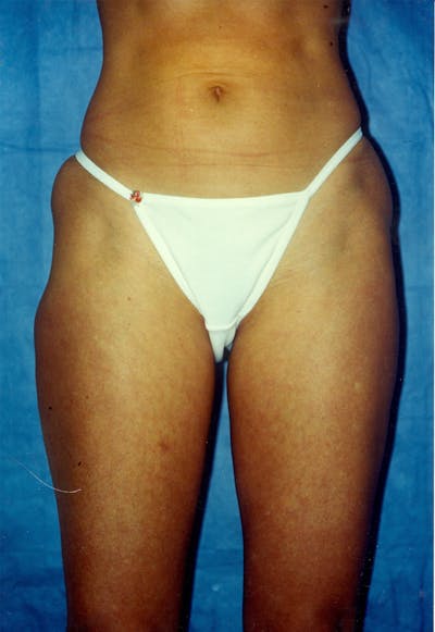 Liposuction Before & After Gallery - Patient 115391375 - Image 1