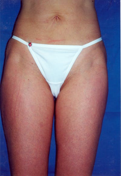 Liposuction Before & After Gallery - Patient 115391375 - Image 2