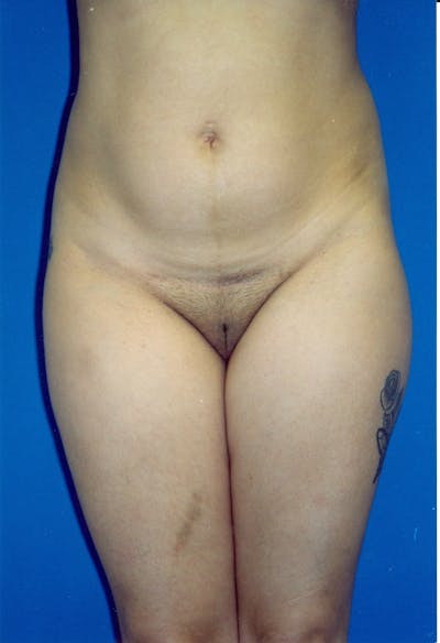 Liposuction Before & After Gallery - Patient 115391422 - Image 1