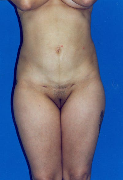 Liposuction Before & After Gallery - Patient 115391422 - Image 2