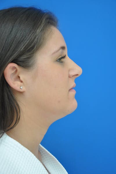 Liposuction Before & After Gallery - Patient 115410814 - Image 1