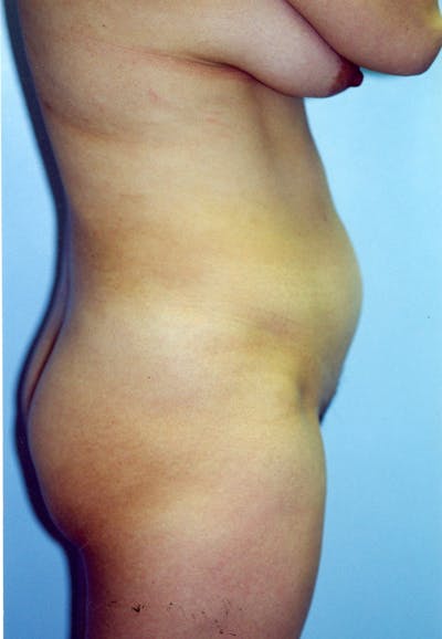 Liposuction Before & After Gallery - Patient 115410818 - Image 1