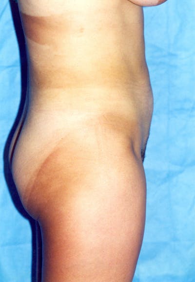 Liposuction Before & After Gallery - Patient 115410818 - Image 2