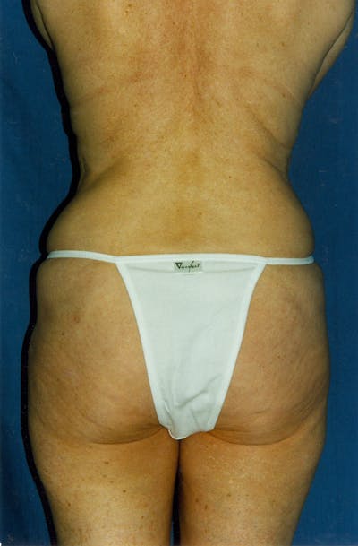 Liposuction Before & After Gallery - Patient 115410824 - Image 2