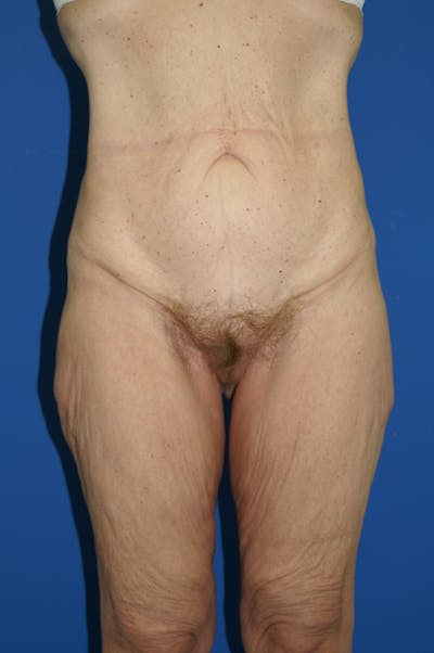 Lower Body Lift Before & After Gallery - Patient 115416839 - Image 1