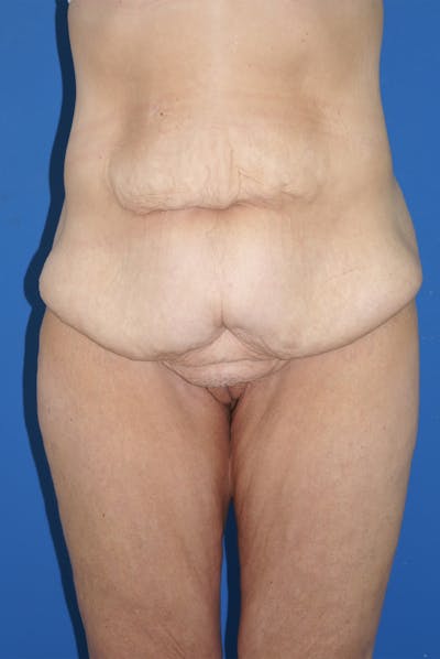 Lower Body Lift Before & After Gallery - Patient 115416874 - Image 1