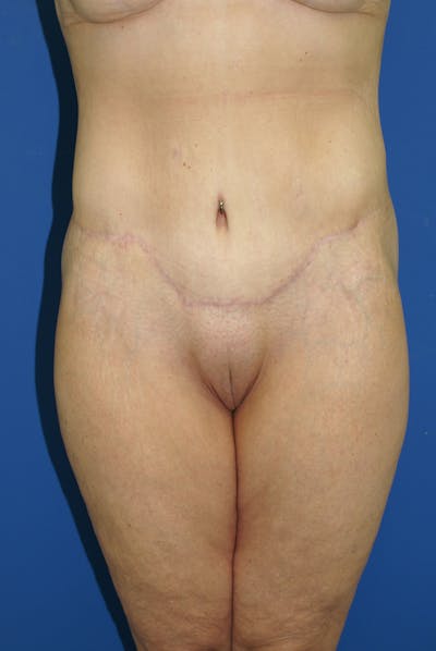 Lower Body Lift Before & After Gallery - Patient 115416874 - Image 2