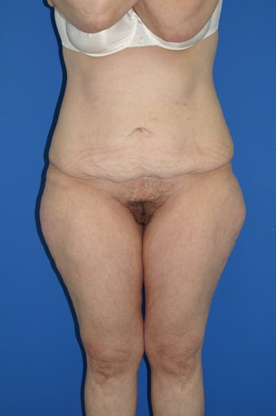 Lower Body Lift Before & After Gallery - Patient 115416890 - Image 1