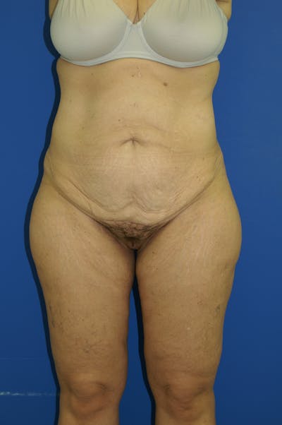 Lower Body Lift Before & After Gallery - Patient 115416926 - Image 1