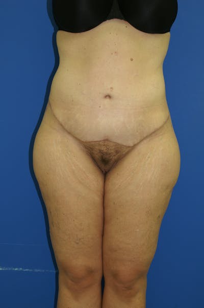 Lower Body Lift Before & After Gallery - Patient 115416926 - Image 2