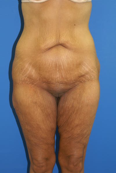 Lower Body Lift Before & After Gallery - Patient 115416957 - Image 1