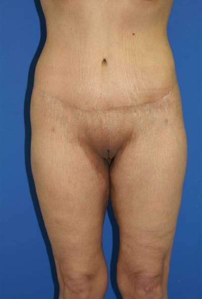 Lower Body Lift Before & After Gallery - Patient 115416957 - Image 2