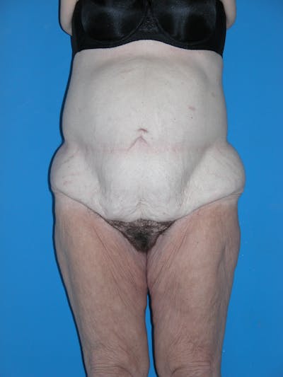 Lower Body Lift Before & After Gallery - Patient 115416966 - Image 1
