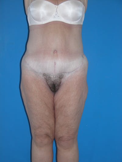 Lower Body Lift Before & After Gallery - Patient 115416966 - Image 2