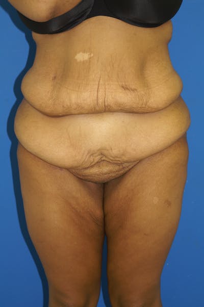 Lower Body Lift Before & After Gallery - Patient 115416984 - Image 1