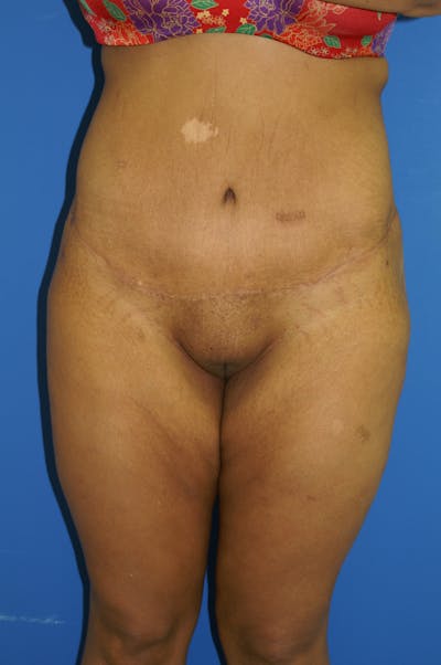 Lower Body Lift Before & After Gallery - Patient 115416984 - Image 2