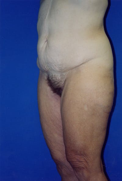 Lower Body Lift Before & After Gallery - Patient 115416989 - Image 1