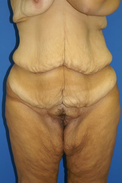Lower Body Lift Before & After Gallery - Patient 115416994 - Image 1