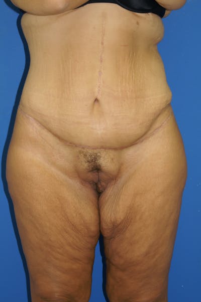Lower Body Lift Before & After Gallery - Patient 115416994 - Image 2