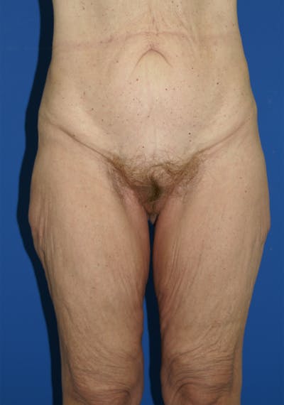 Thigh Lift Before & After Gallery - Patient 115449513 - Image 1