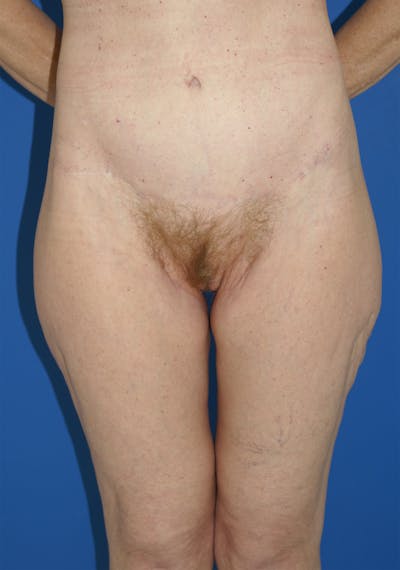 Thigh Lift Before & After Gallery - Patient 115449513 - Image 2