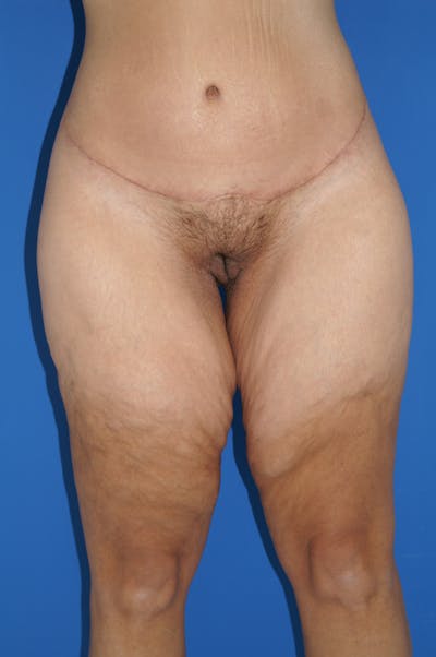 Thigh Lift Before & After Gallery - Patient 115449539 - Image 1