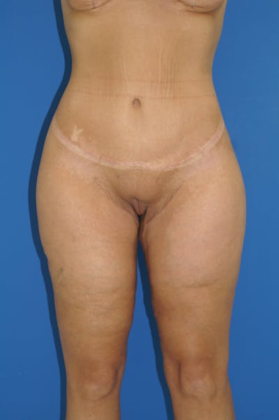 Thigh Lift Before & After Gallery - Patient 115449539 - Image 2