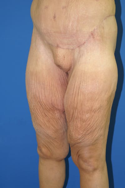 Thigh Lift Before & After Gallery - Patient 115449543 - Image 1