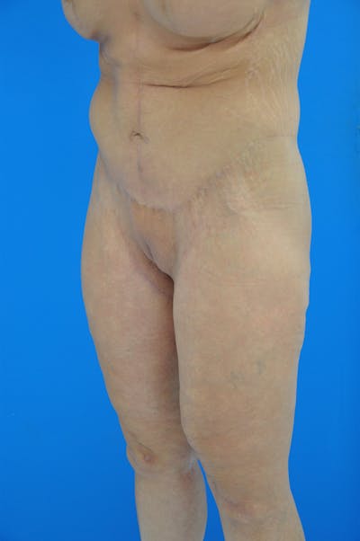 Thigh Lift Before & After Gallery - Patient 115449543 - Image 2