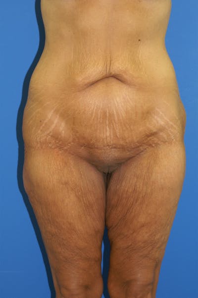Thigh Lift Before & After Gallery - Patient 115449552 - Image 1