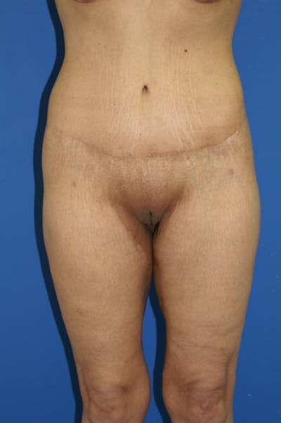 Thigh Lift Before & After Gallery - Patient 115449552 - Image 2