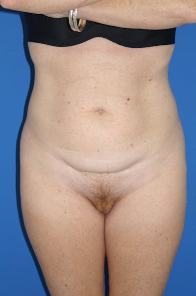 Tummy Tuck Before & After Gallery - Patient 115449954 - Image 1