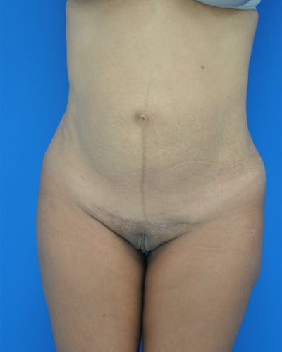 Tummy Tuck Before & After Gallery - Patient 115449961 - Image 1