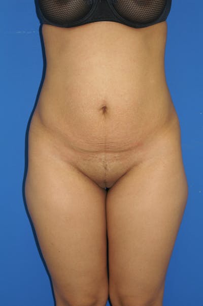 Tummy Tuck Before & After Gallery - Patient 115450026 - Image 1