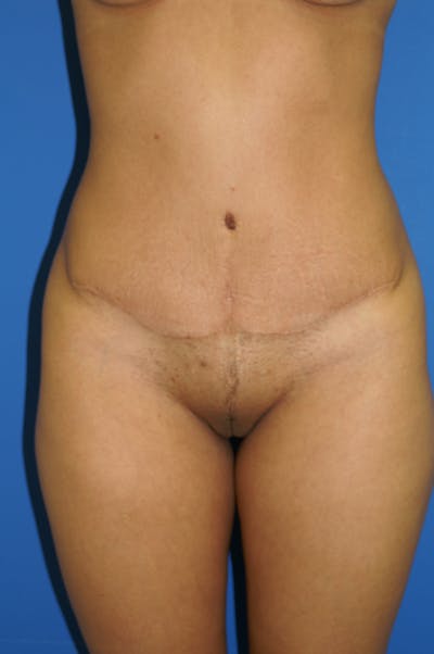 Tummy Tuck Before & After Gallery - Patient 115450026 - Image 2