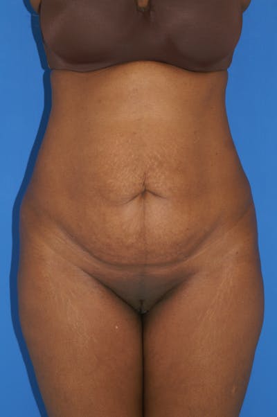Tummy Tuck Before & After Gallery - Patient 115450078 - Image 1