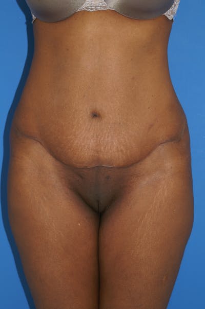 Tummy Tuck Before & After Gallery - Patient 115450078 - Image 2