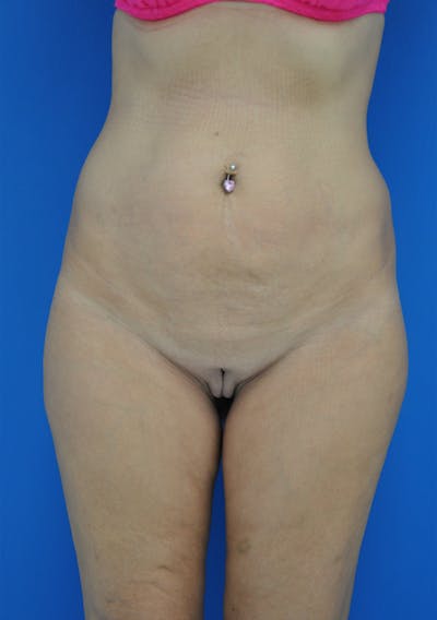 Tummy Tuck Before & After Gallery - Patient 115450104 - Image 1