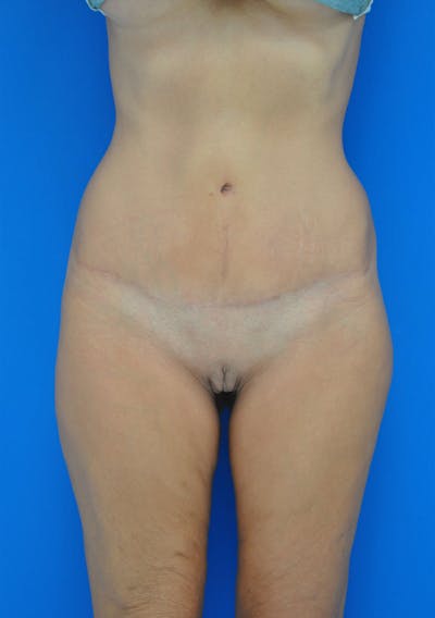 Tummy Tuck Before & After Gallery - Patient 115450104 - Image 2