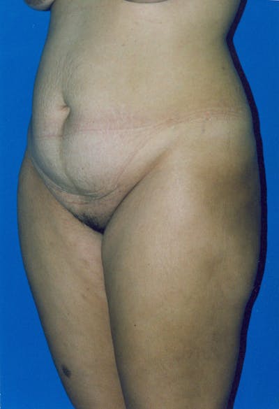 Tummy Tuck Before & After Gallery - Patient 115450127 - Image 1