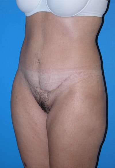 Tummy Tuck Before & After Gallery - Patient 115450127 - Image 2
