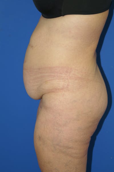 Tummy Tuck Before & After Gallery - Patient 115450161 - Image 1