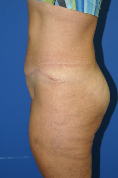 Tummy Tuck Before & After Gallery - Patient 115450161 - Image 2
