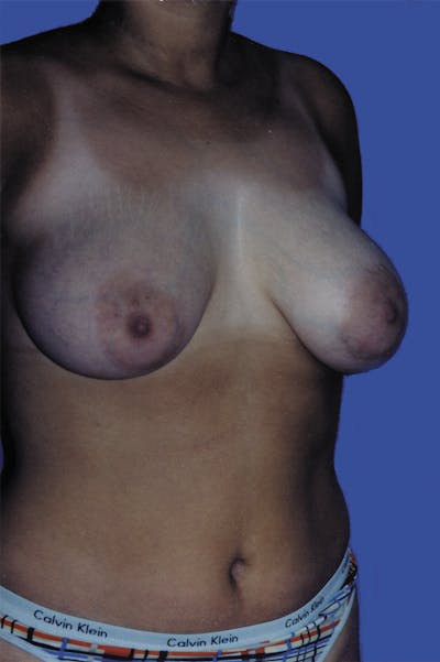 Breast Lift Before & After Gallery - Patient 116240475 - Image 1