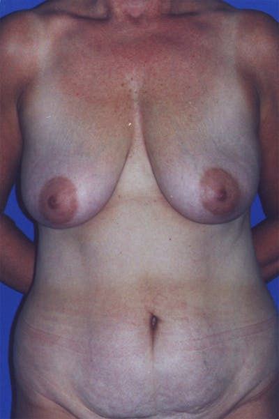 Breast Lift Before & After Gallery - Patient 116240575 - Image 1