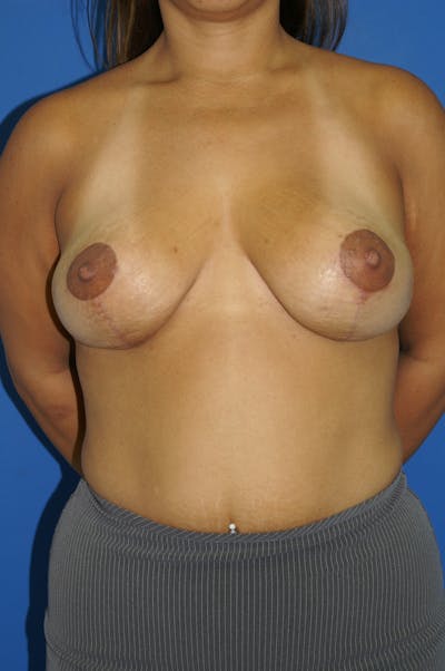 Breast Lift Before & After Gallery - Patient 116241969 - Image 2