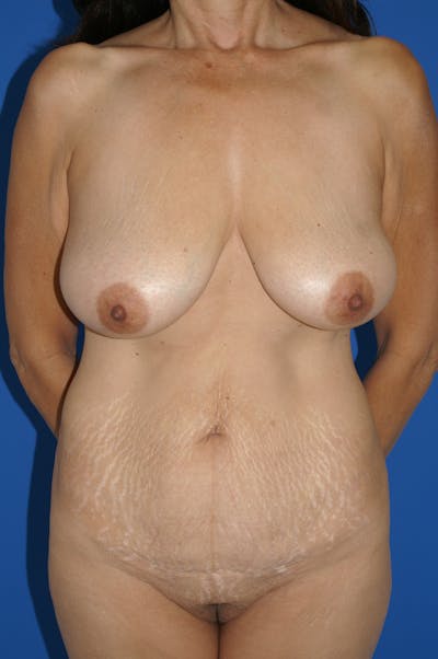 Breast Lift Before & After Gallery - Patient 116242018 - Image 1