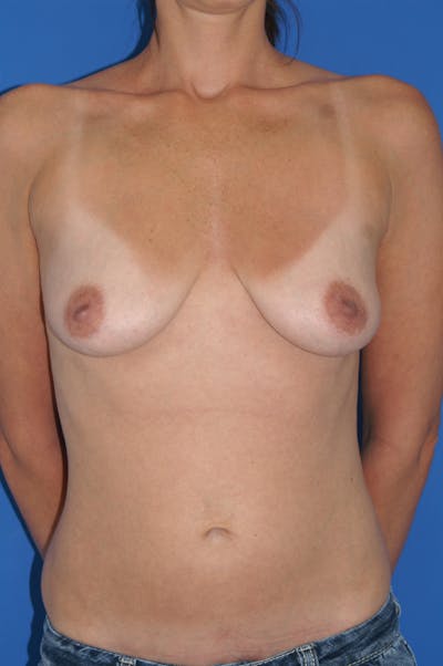Breast Lift With Implant Before & After Gallery - Patient 116242986 - Image 1