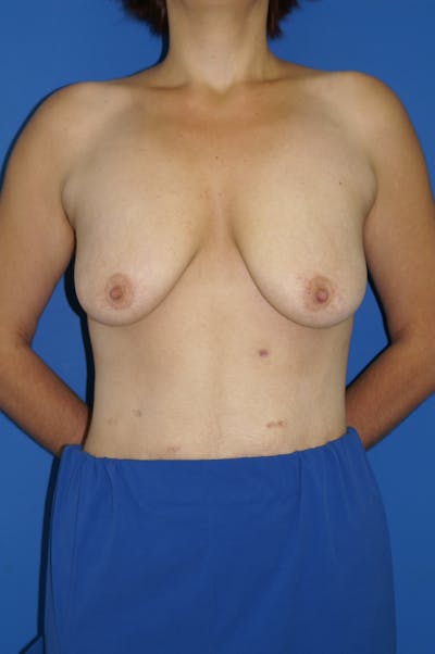 Breast Lift With Implant Before & After Gallery - Patient 116243038 - Image 1