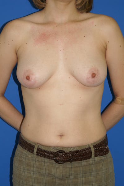Breast Lift With Implant Before & After Gallery - Patient 116243060 - Image 1